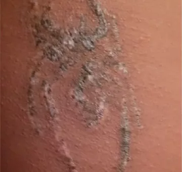 laser-tattoo-removal-services-in-nairobi-kenya