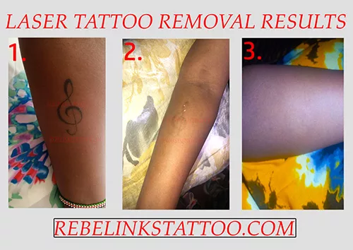 arm-laser-tattoo-removal-progress-photos