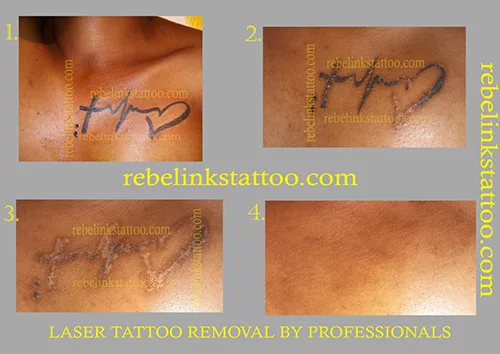 chest-laser-tattoo-removal-progress-photos