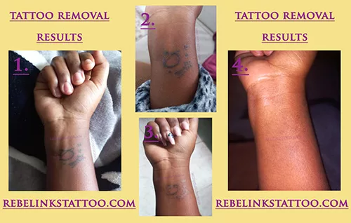 forearm-laser-tattoo-removal-progress-photos