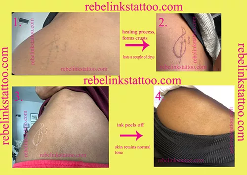 laser-tattoo-removal-progress-photos