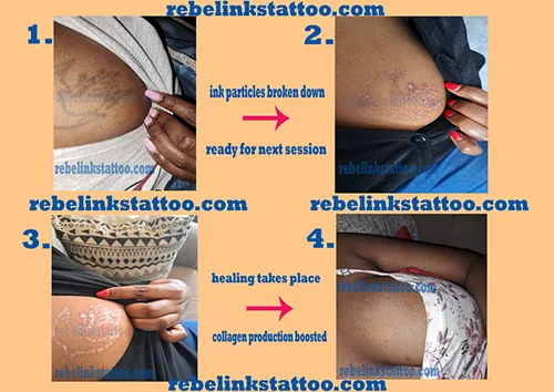 laser-tattoo-removal-progress-photos