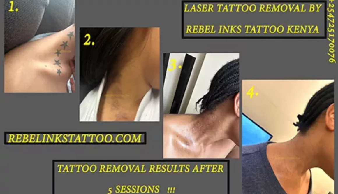neck-laser-tattoo-removal-progress-photos