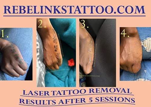 wrist-laser-tattoo-removal-progress-photos