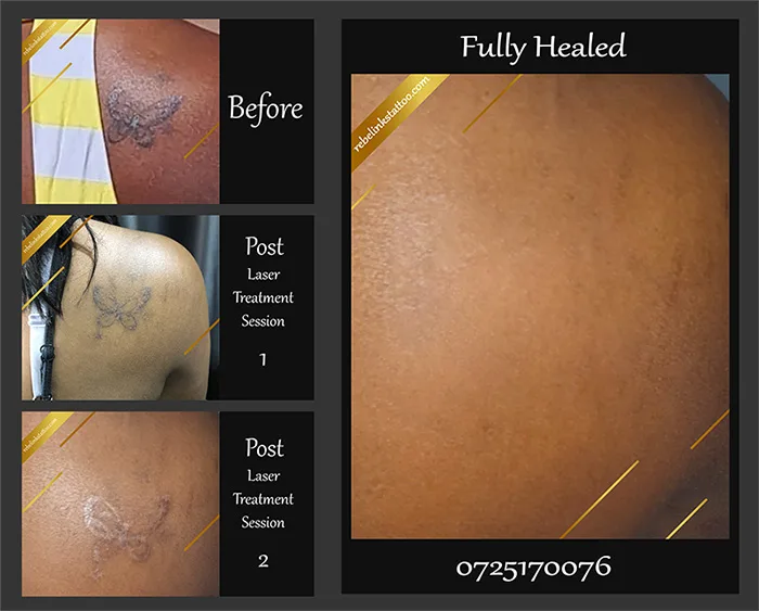 fractional-laser-tattoo-removal