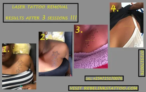 q-switched-nd-yag-laser-tattoo-removal