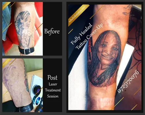 laser-tattoo-removal-and-cover-up-progress