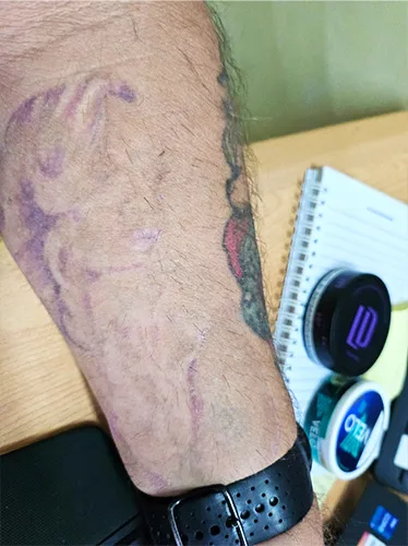 Post Laser Tattoo Removal