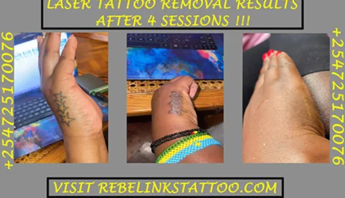 laser-tattoo-removal-progress-of-star-hand-tattoo