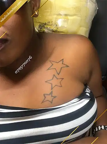 q-switched-nd-yag-laser-tattoo-removal-of-star-tattoos