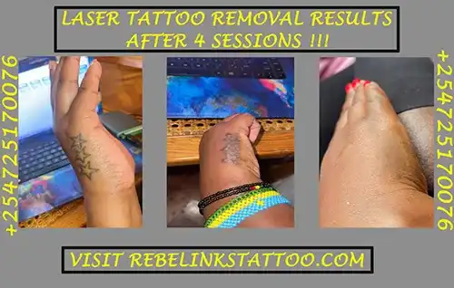 laser-star-tattoo-removal-progress