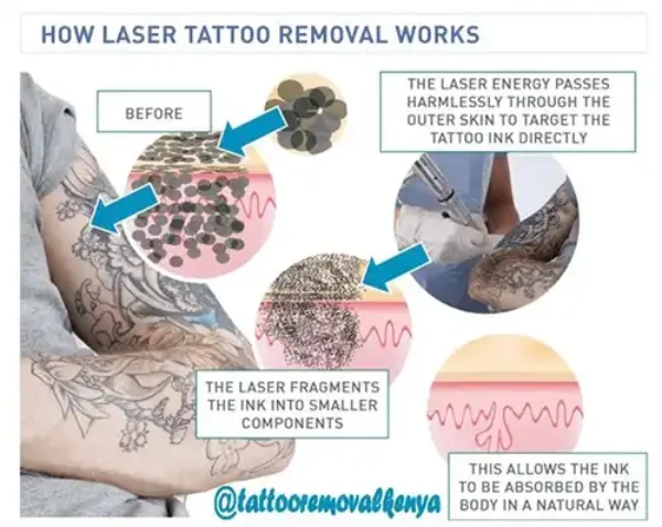 laser-tattoo-removal-process