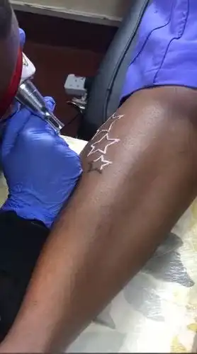 laser-tattoo-Removal-service-in-nairobi