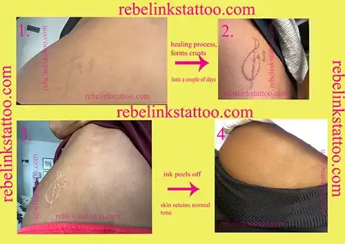 laser-tattoo-removal-progress-images
