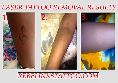 arm-laser-tattoo-removal-progress