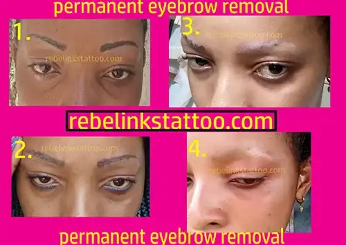 eyebrow-laser-tattoo-removal-progress