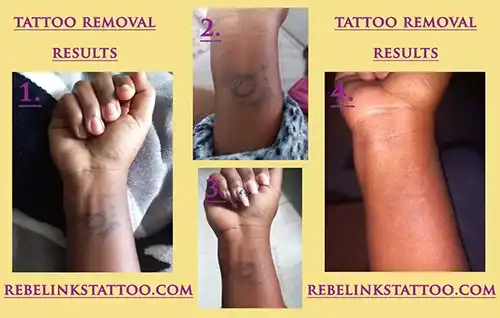 fore-arm-laser-tattoo-removal-progress-photos