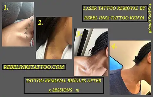 neck-laser-tattoo-removal-progress