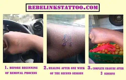 wrist-laser-tattoo-removal-progress-sessions