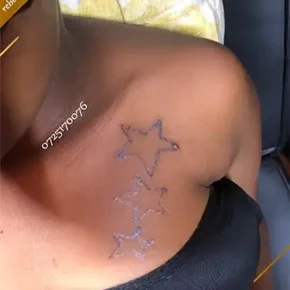 q-switched-nd-yag-laser-star-tattoos-removal-post-session-1