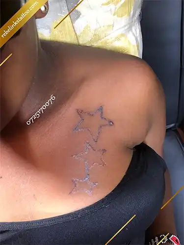 q-switched-nd-yag-laser-star-tattoos-removal-post-session-1