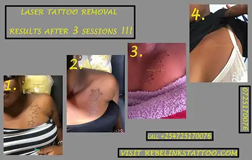 q-switched-nd-yag-laser-tattoo-removal-progress