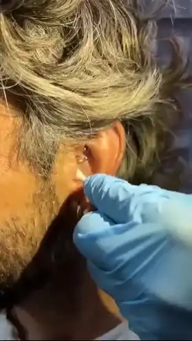 daith-piercing