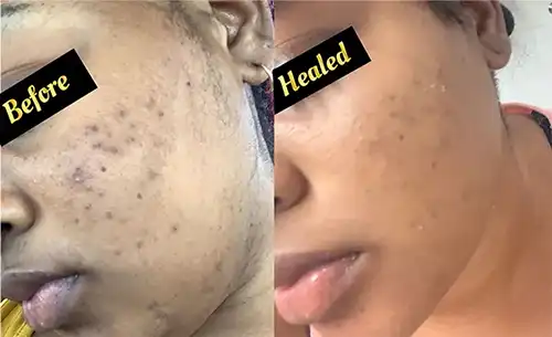 black-dark-spot-laser-removal-treatment