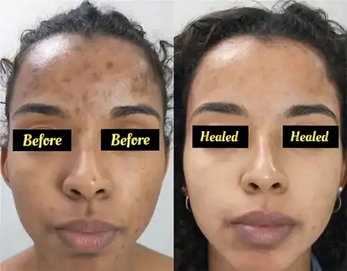 melasma-laser-treatment