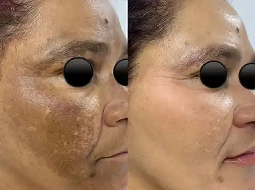 melasma-laser-treatment