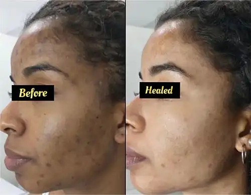 melasma-laser-treatment