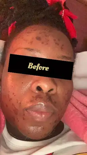 black-dark-spot-laser-removal-treatment