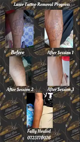 laser-tattoo-removal-before-and-after-progress