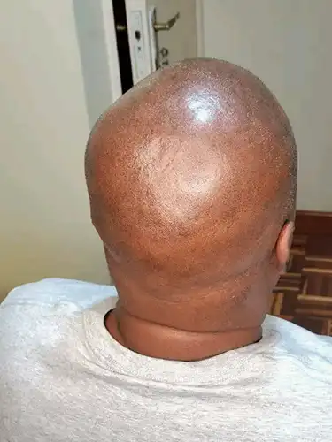 Scalp Micropigmentation back side