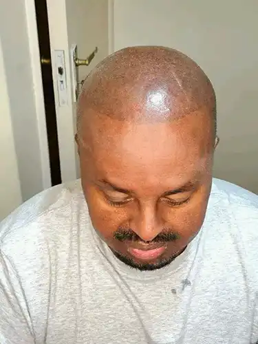 Scalp Micropigmentation front side