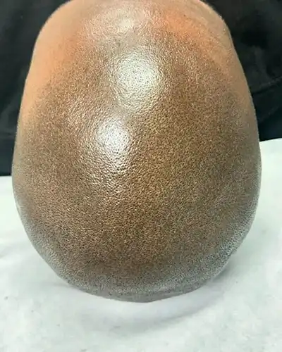 After Scalp Micropigmentation Procedure