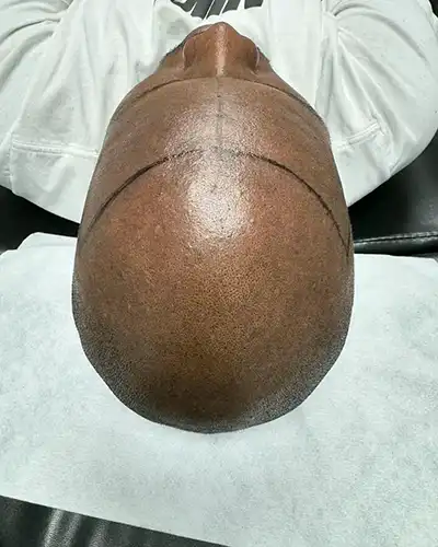 Before Scalp Micropigmentation