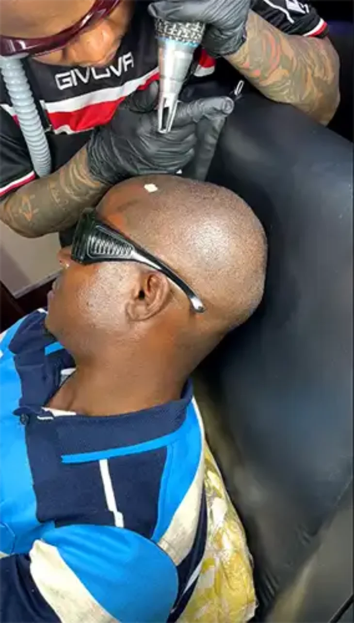 Scalp-Micropigmentation-Correction scalp-micropigmentation-correction