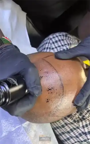 scalp-micropigmentation